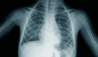 röntgensugárzás és mindez